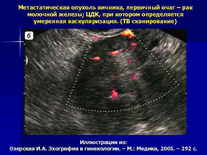 Метастатическая опухоль яичника, первичный очаг – рак молочной железы; ЦДК, при котором определяется умеренная