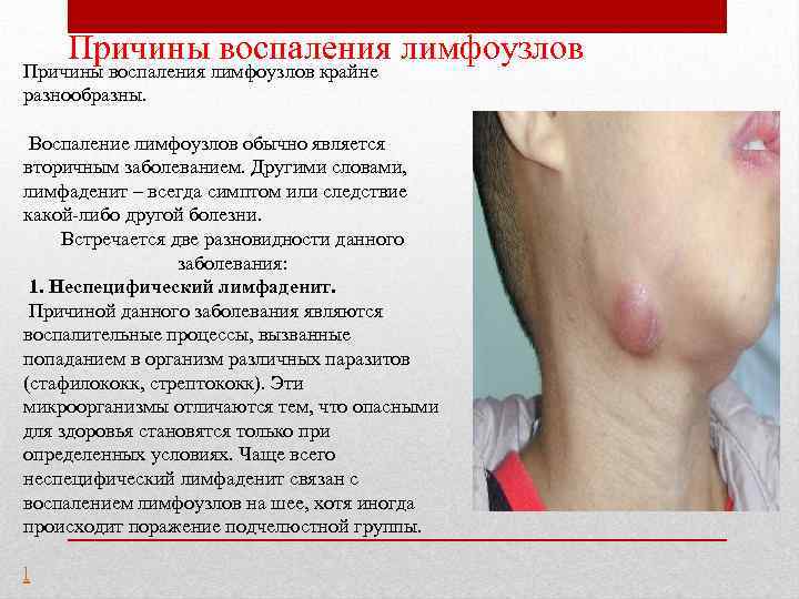 Причины воспаления лимфоузлов крайне разнообразны. Воспаление лимфоузлов обычно является вторичным заболеванием. Другими словами, лимфаденит