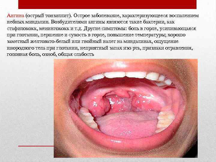 Ангина (острый тонзиллит). Острое заболевание, характеризующееся воспалением небных миндалин. Возбудителями ангины являются такие бактерии,