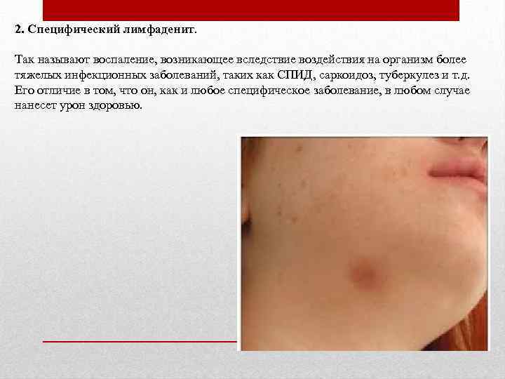 2. Специфический лимфаденит. Так называют воспаление, возникающее вследствие воздействия на организм более тяжелых инфекционных