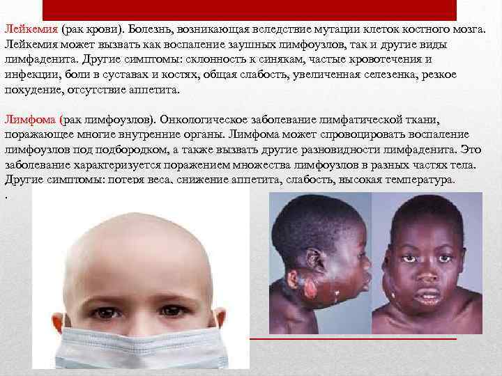 Лейкемия (рак крови). Болезнь, возникающая вследствие мутации клеток костного мозга. Лейкемия может вызвать как