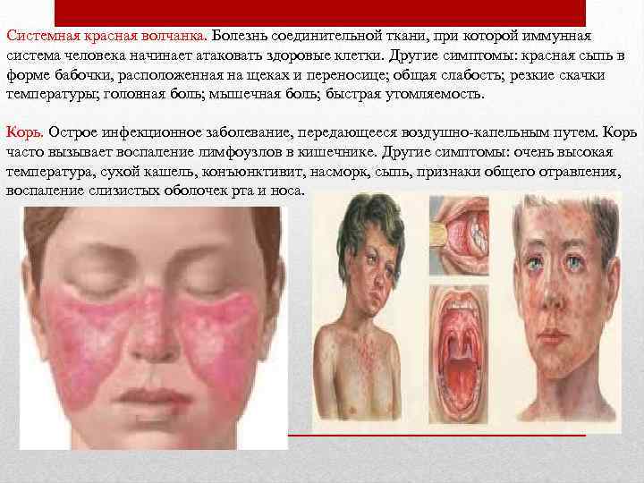 Системная красная волчанка. Болезнь соединительной ткани, при которой иммунная система человека начинает атаковать здоровые