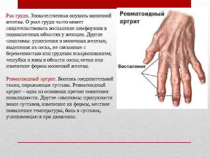 Рак груди. Злокачественная опухоль молочной железы. О раке груди часто может свидетельствовать воспаление лимфоузлов
