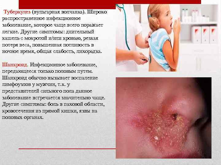  Туберкулез (вульгарная волчанка). Широко распространенное инфекционное заболевание, которое чаще всего поражает легкие. Другие