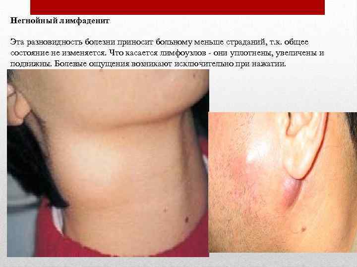 Негнойный лимфаденит Эта разновидность болезни приносит больному меньше страданий, т. к. общее состояние не