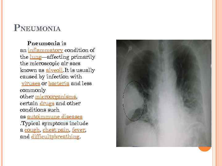 PNEUMONIA Pneumonia is an inflammatory condition of the lung—affecting primarily the microscopic air sacs
