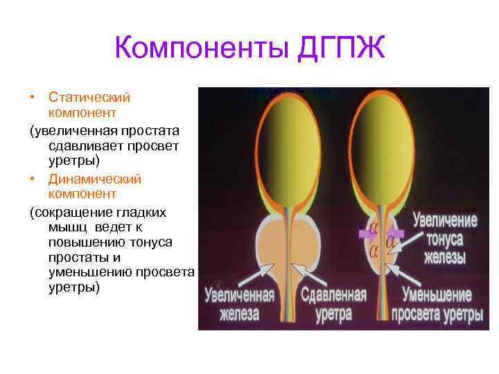 Компоненты ДГПЖ • Статический компонент (увеличенная простата сдавливает просвет уретры) • Динамический компонент (сокращение