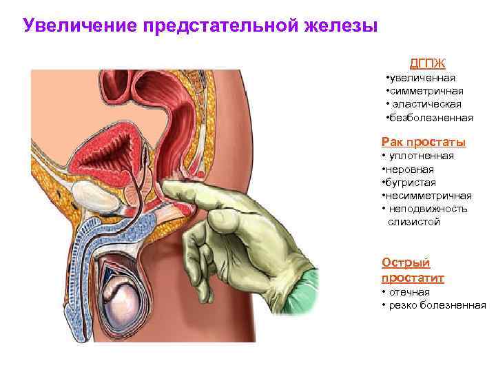 Увеличение предстательной железы ДГПЖ • увеличенная • симметричная • эластическая • безболезненная Рак простаты