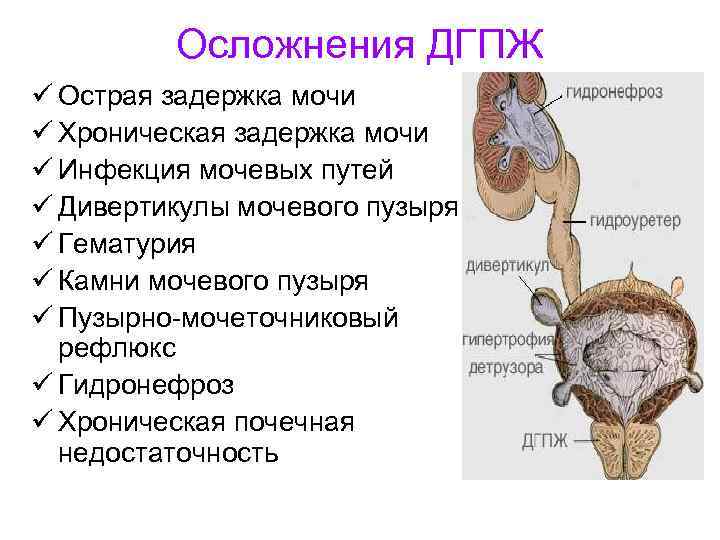 Осложнения ДГПЖ ü Острая задержка мочи ü Хроническая задержка мочи ü Инфекция мочевых путей