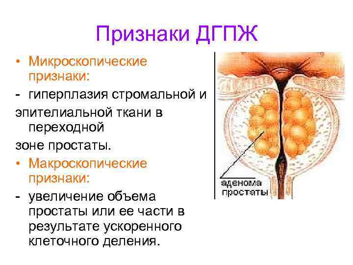 Признаки ДГПЖ • Микроскопические признаки: - гиперплазия стромальной и эпителиальной ткани в переходной зоне