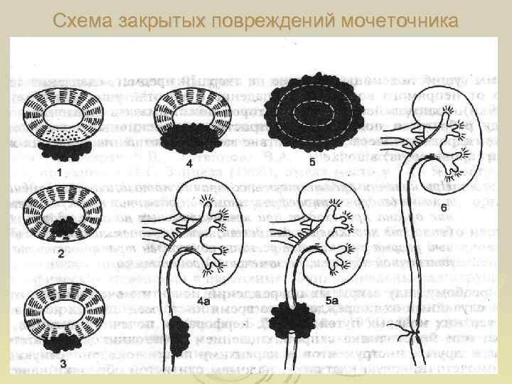 Схема закрытых повреждений мочеточника 