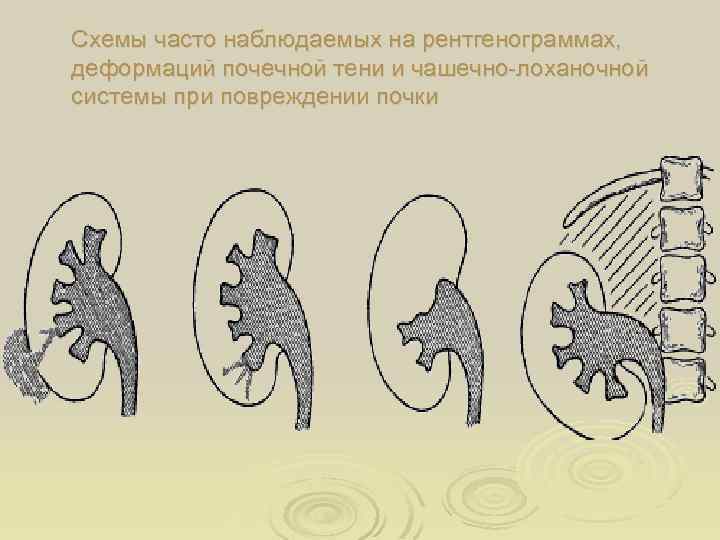 Схемы часто наблюдаемых на рентгенограммах, деформаций почечной тени и чашечно-лоханочной системы при повреждении почки