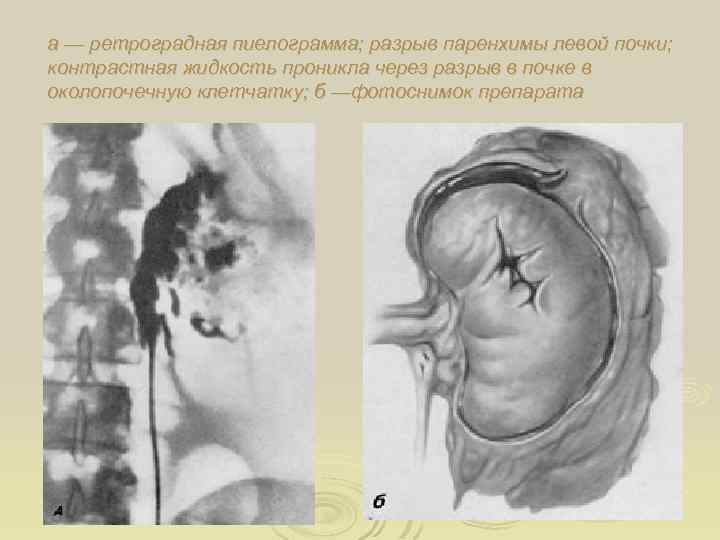 а — ретроградная пиелограмма; разрыв паренхимы левой почки; контрастная жидкость проникла через разрыв в