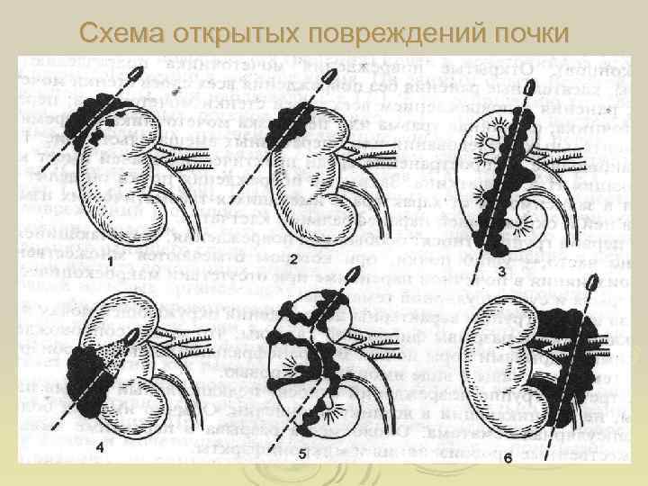 Схема открытых повреждений почки 