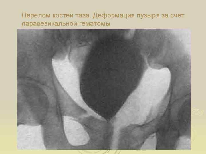 Перелом костей таза. Деформация пузыря за счет паравезикальной гематомы 