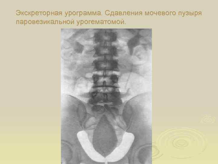 Экскреторная урограмма. Сдавления мочевого пузыря паровезикальной урогематомой. 