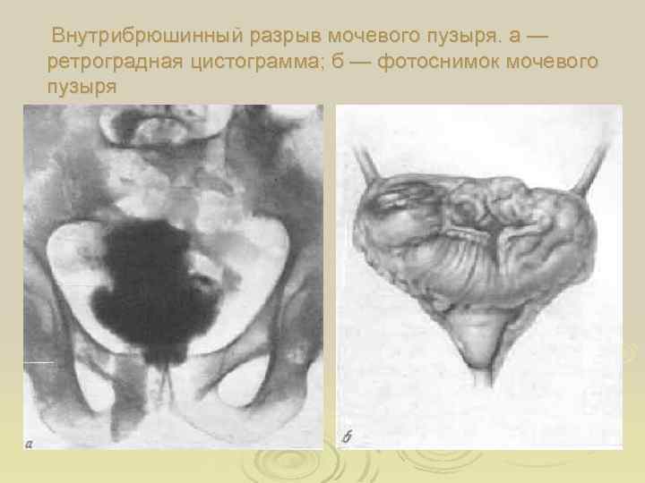 Внутрибрюшинный разрыв мочевого пузыря. а — ретроградная цистограмма; б — фотоснимок мочевого пузыря 