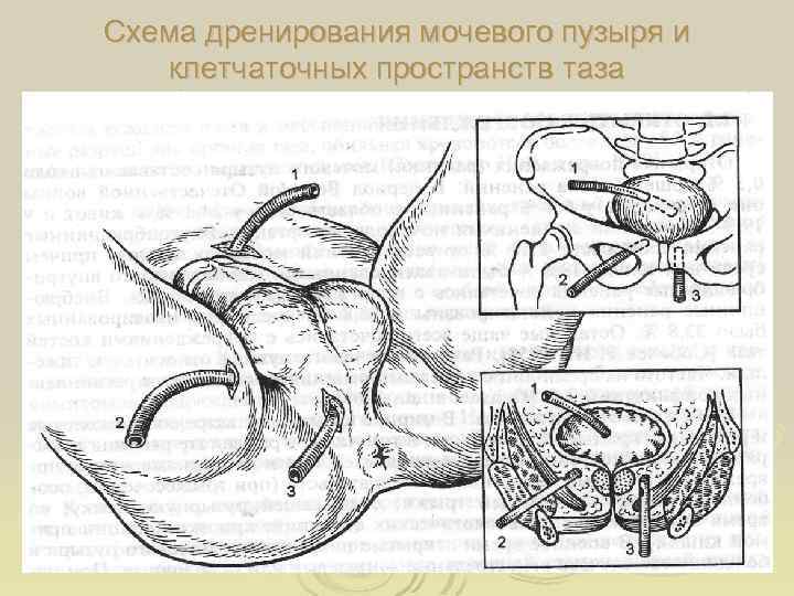 Схема дренирования мочевого пузыря и клетчаточных пространств таза 