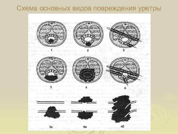 Схема основных видов повреждения уретры 