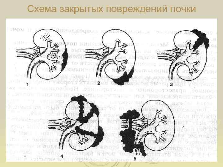 Схема закрытых повреждений почки 