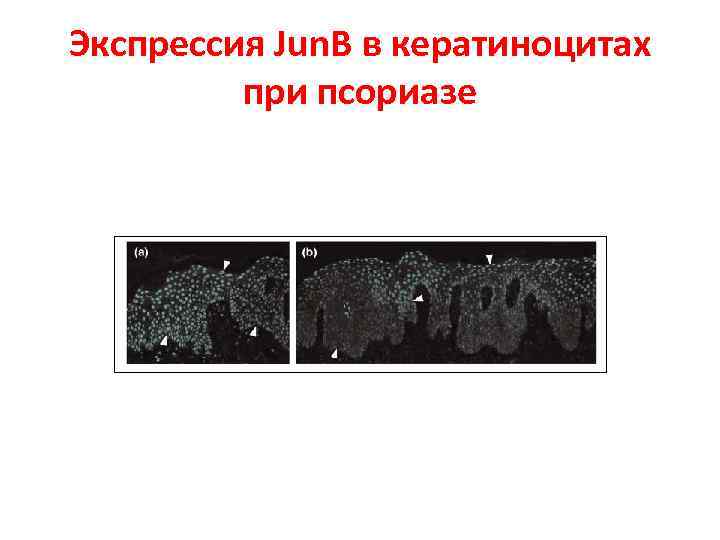 Экспрессия Jun. B в кератиноцитах при псориазе 