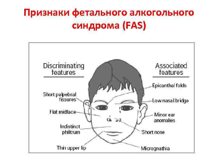 Признаки фетального алкогольного синдрома (FAS) 