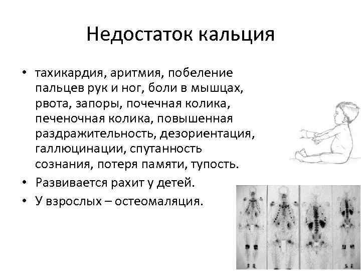 Недостаток кальция • тахикардия, аритмия, побеление пальцев рук и ног, боли в мышцах, рвота,
