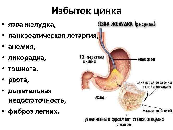 Избыток цинка язва желудка, панкреатическая летаргия, анемия, лихорадка, тошнота, рвота, дыхательная недостаточность, • фиброз