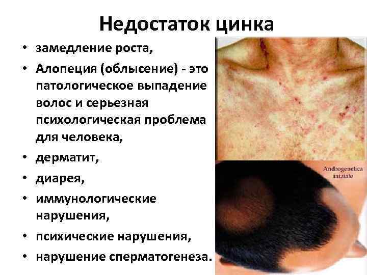 Недостаток цинка • замедление роста, • Алопеция (облысение) - это патологическое выпадение волос и