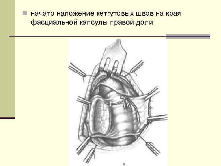 n начато наложение кетгутовых швов на края фасциальной капсулы правой доли 