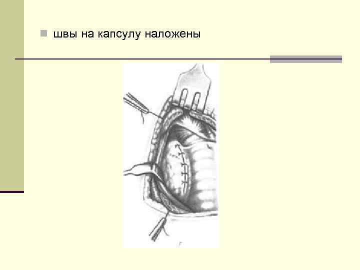 n швы на капсулу наложены 