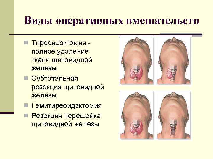 Виды оперативных вмешательств n Тиреоидэктомия - полное удаление ткани щитовидной железы n Субтотальная резекция