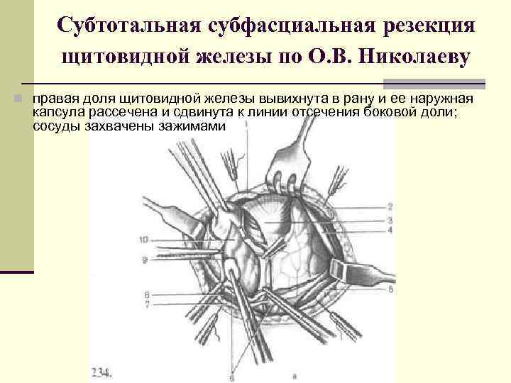 Субтотальная субфасциальная резекция щитовидной железы по О. В. Николаеву n правая доля щитовидной железы