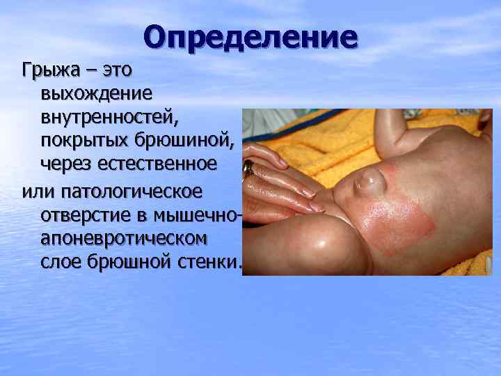 Определение Грыжа – это выхождение внутренностей, покрытых брюшиной, через естественное или патологическое отверстие в