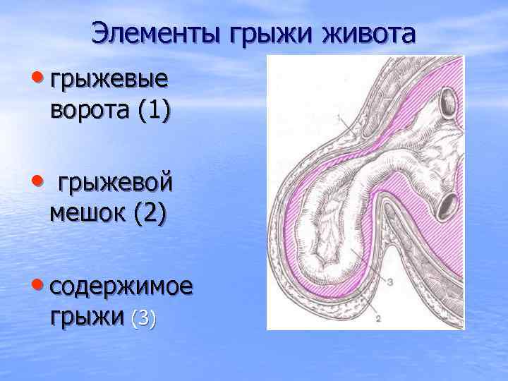 Элементы грыжи живота • грыжевые ворота (1) • грыжевой мешок (2) • содержимое грыжи