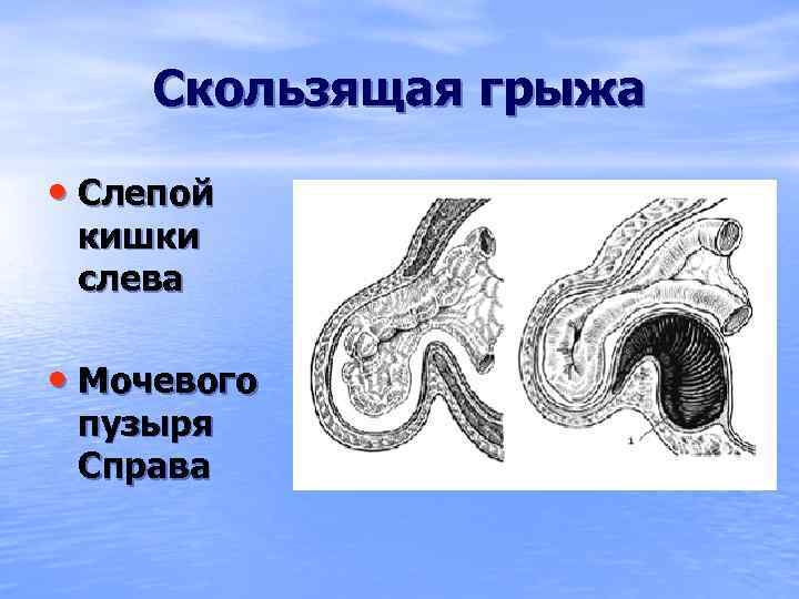 Скользящая грыжа. Скользящая грыжа слепой кишки. Скользящая грыжа кишечника. Скользящая грыжа мочевого пузыря.