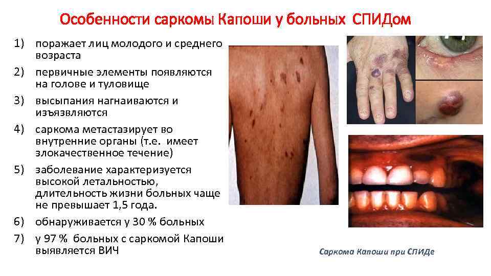 Особенности саркомы Капоши у больных СПИДом 1) поражает лиц молодого и среднего возраста 2)