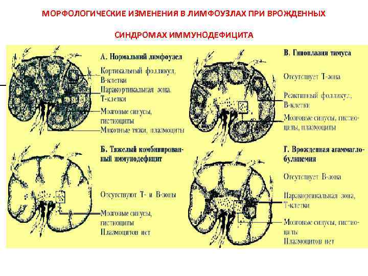 МОРФОЛОГИЧЕСКИЕ ИЗМЕНЕНИЯ В ЛИМФОУЗЛАХ ПРИ ВРОЖДЕННЫХ СИНДРОМАХ ИММУНОДЕФИЦИТА 