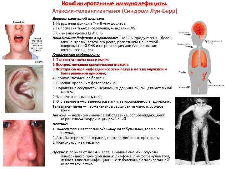 Комбинированные иммунодефициты. Атаксия-телеангиэктазия (Синдром Луи-Барр) Дефект иммунной системы: 1. Нарушения функции Т- и В-лимфоцитов.