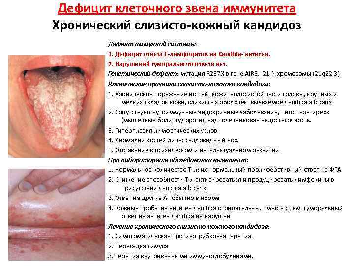 Дефицит клеточного звена иммунитета Хронический слизисто-кожный кандидоз Дефект иммунной системы: 1. Дефицит ответа Т-лимфоцитов