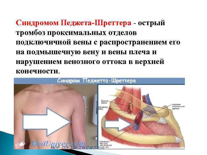 Синдромом Педжета-Шреттера острый тромбоз проксимальных отделов подключичной вены с распространением его на подмышечную вену