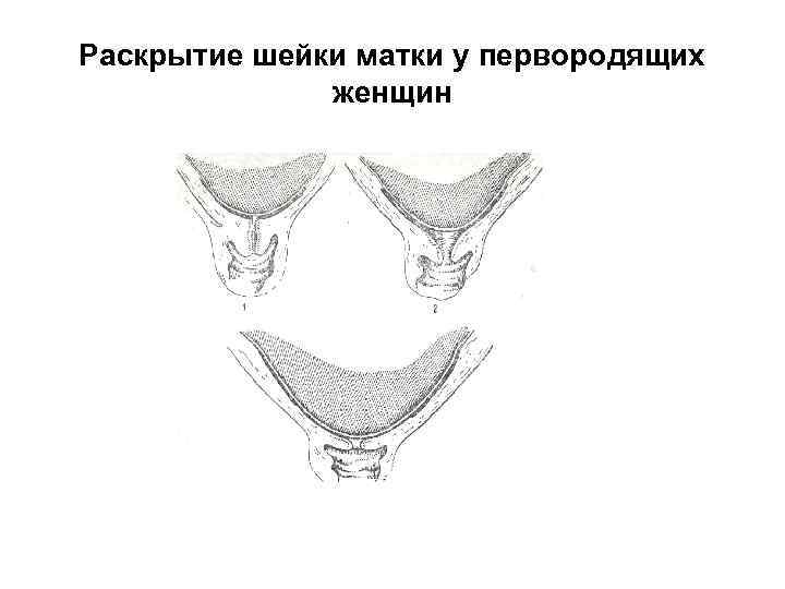 Раскрытие шейки матки у первородящих женщин 