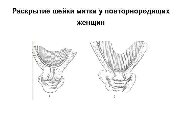 Раскрытие шейки матки. Шейка матки у повторнородящих.