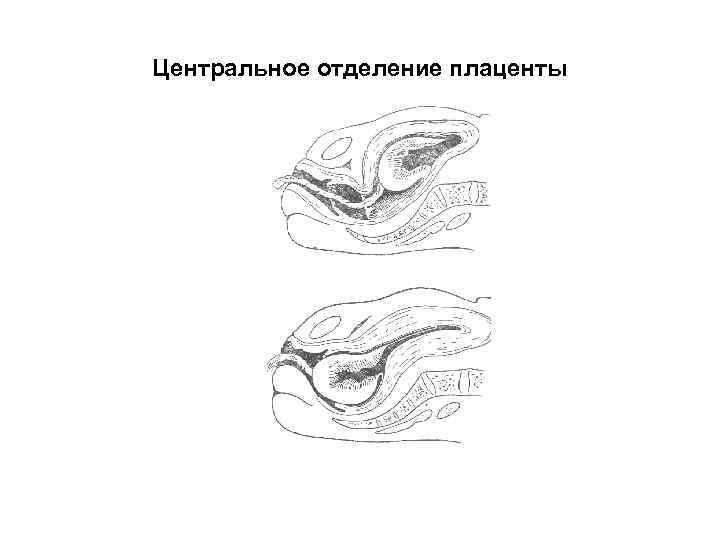 Способы отделения. Отделение последа по Шульцу и Дункану. Отделение последа по Дункану. Механизм отделения последа. Механизмы отделения плаценты по Шульцу и Дункану.