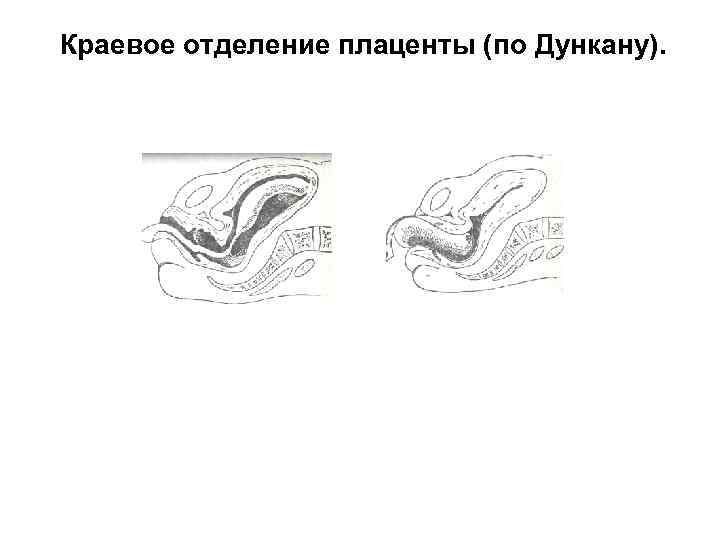 Краевое отделение плаценты (по Дункану). 