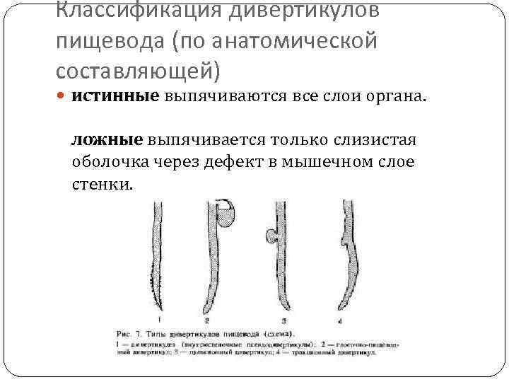 Классификация дивертикулов пищевода (по анатомической составляющей) истинные выпячиваются все слои органа. ложные выпячивается только
