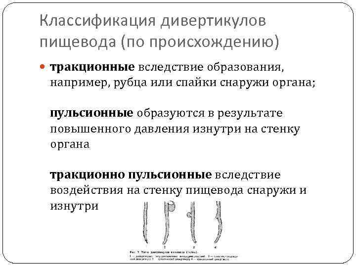 Классификация дивертикулов пищевода (по происхождению) тракционные вследствие образования, например, рубца или спайки снаружи органа;