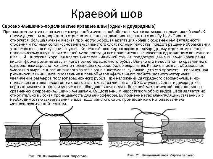 Кишечный шов. Однорядный кишечный шов техника. Краевой серозно-мышечно-подслизистый шов Пирогова. Двухрядный кишечный шов преимущества. Краевые кишечные швы.