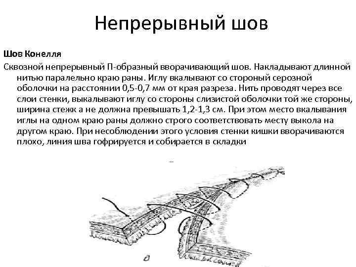 Наложение шва латынь. Сквозной непрерывный кишечный шов. П образный шов вворачивающий шов. Непрерывный п образный шов. П-образный кишечный шов.