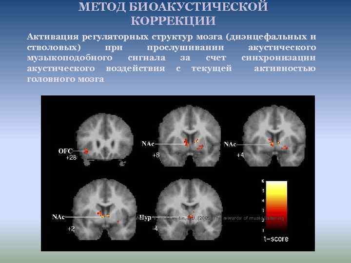 МЕТОД БИОАКУСТИЧЕСКОЙ КОРРЕКЦИИ Активация регуляторных структур мозга (диэнцефальных и стволовых) при прослушивании акустического музыкоподобного